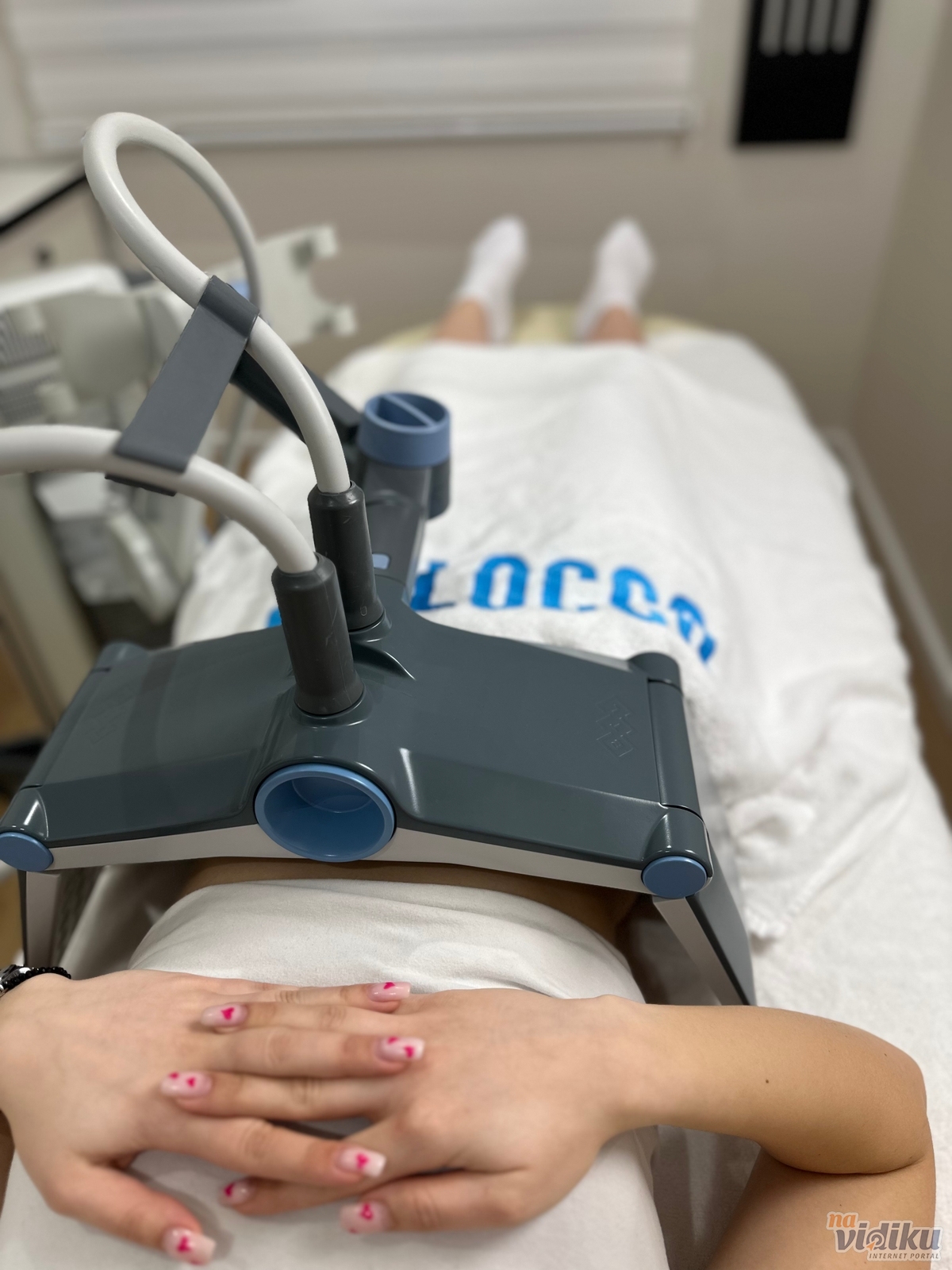 Neinvazivna liposukcija, Mršavljenje In Locco slike