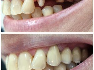 popravka-lecenje-i-vadjenje-zuba-68d176-5.jpg