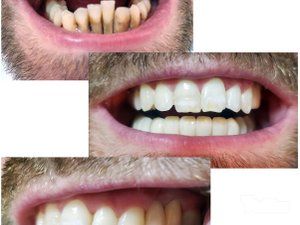 popravka-lecenje-i-vadjenje-zuba-68d176-6.jpg