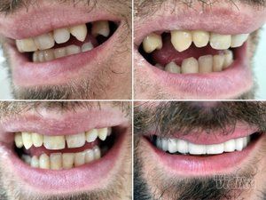 popravka-lecenje-i-vadjenje-zuba-68d176-7.jpg