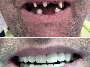 popravka-lecenje-i-vadjenje-zuba-68d176-8.jpg