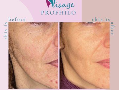 Visage Smile estetska medicina