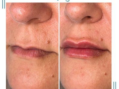 Visage Smile estetska medicina