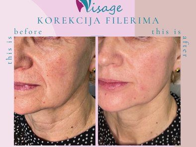 Visage Smile estetska medicina
