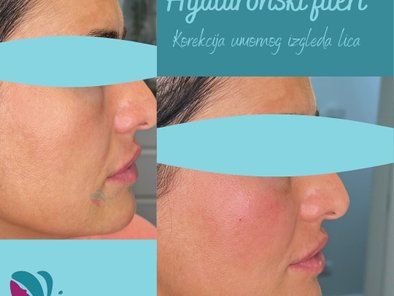 Visage Smile estetska medicina