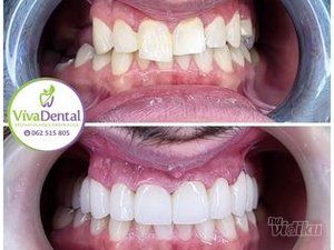zubne-krunice-beljenje-zuba-protetika-sabac-0efad8-249eda43-1.jpg