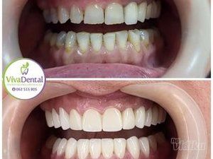 zubne-krunice-beljenje-zuba-protetika-sabac-0efad8-324acfcd-1.jpg