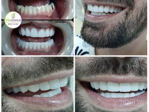 zubne-krunice-beljenje-zuba-protetika-sabac-0efad8-5fd3f7b8-1.jpg
