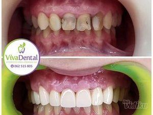 zubne-krunice-beljenje-zuba-protetika-sabac-0efad8-692d2d55-1.jpg