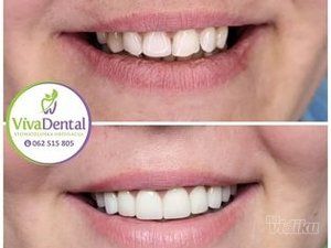 zubne-krunice-beljenje-zuba-protetika-sabac-0efad8-cc159c44-1.jpg