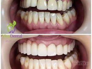 zubne-krunice-beljenje-zuba-protetika-sabac-0efad8-d0bc80b1-1.jpg