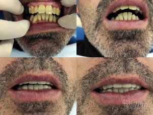 zubne-krunice-novi-beograd-21181c-13.jpg