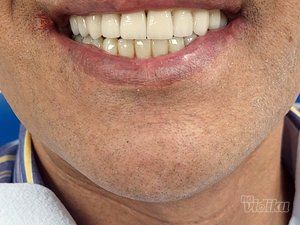 zubne-krunice-novi-beograd-21181c-15.jpg