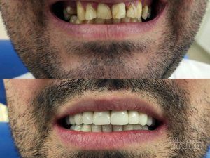 zubne-krunice-novi-beograd-21181c-16.jpg