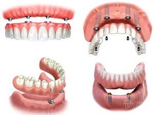 zubne-krunice-novi-beograd-21181c-8.jpg