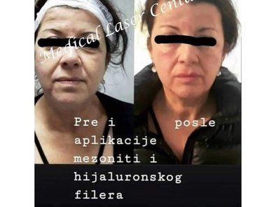 Estetic Anti Aging Medical Laser Centar