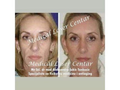 Estetic Anti Aging Medical Laser Centar