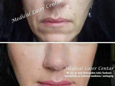 Estetic Anti Aging Medical Laser Centar