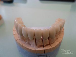 zubni-implantati-bca7de-10.jpg