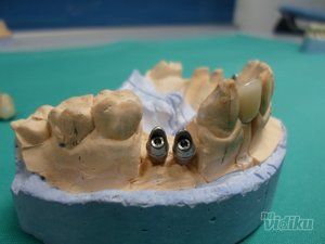 zubni-implantati-bca7de-11.jpg