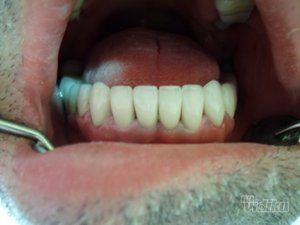 zubni-implantati-bca7de-12.jpg