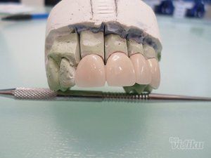 zubni-implantati-bca7de-13.jpg