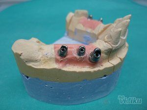 zubni-implantati-bca7de-16.jpg
