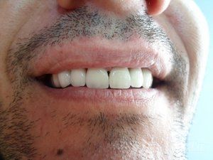 zubni-implantati-bca7de-17.jpg