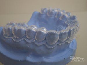 zubni-implantati-bca7de-18.jpg