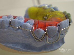 zubni-implantati-bca7de-6.jpg
