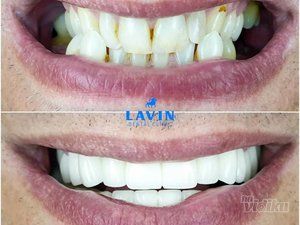 lavin-dental-clinic-stomatoloska-ordinacija-b7c158-2.jpg