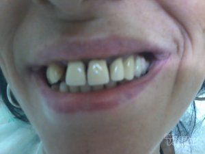 beljenje-zuba-novi-beograd-287d55-6.jpg