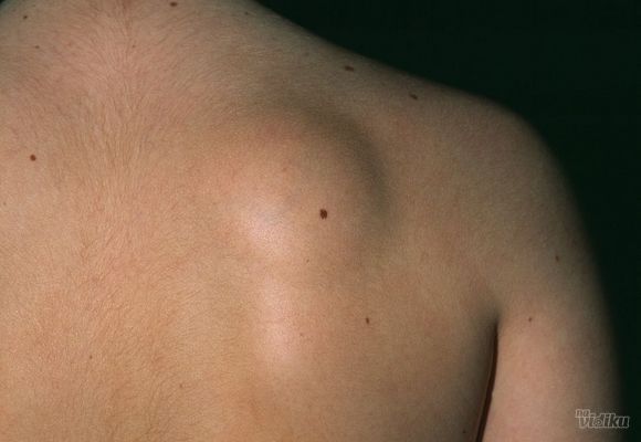 Operacija ateroma i lipoma