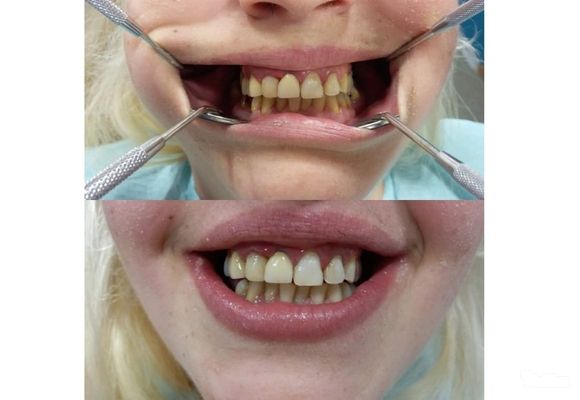 Ordinacijsko izbeljivanje zuba (obe vilice)