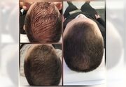 PRP kose + mezoterapija kose (ceo skalp)
