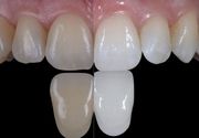 Ordinacijsko beljenje zuba (obe vilice) + uklanjanje kamenca GRATIS