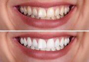 Ordinacijsko izbeljivanje zuba gornje i donje vilice i uklanjanje zubnog kamenca