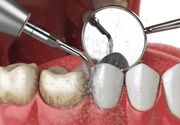 Uklanjanje kamenca sa peskiranjem zuba i obukom o oralnoj higijeni