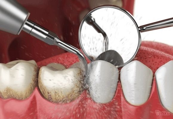 Uklanjanje kamenca sa peskiranjem zuba i obukom o oralnoj higijeni
