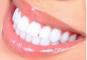 Kućno beljenje zuba Opalescence materijalom!