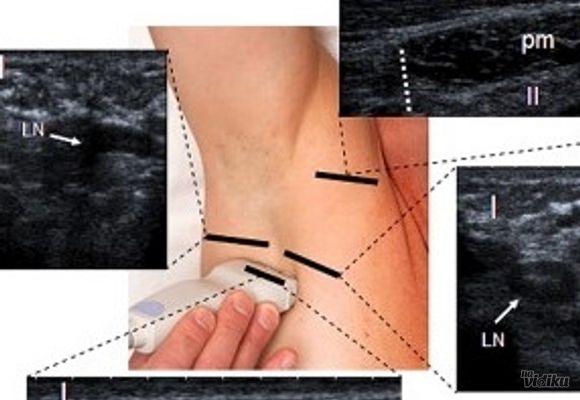 Ultrazvuk mekih tkiva vrata ili pazušnih jama ili prepona