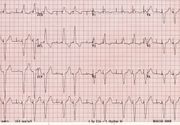 Holter 24h EKG, čitanje holter EKG-a radi kardiolog (zaključak i terapija)