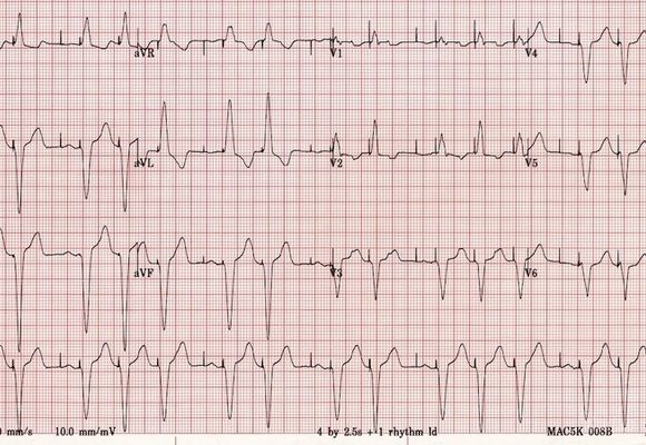 Holter 24h EKG, čitanje holter EKG-a radi kardiolog (zaključak i terapija)