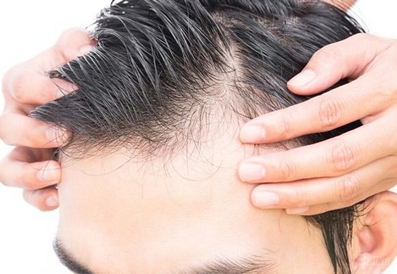 Mezoterapija kose za zaustavljanje opadanja i stimulaciju ponovnog rasta
