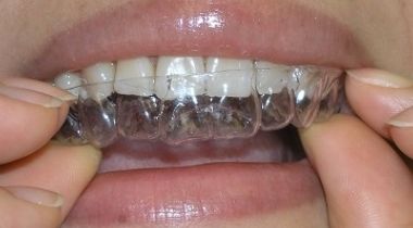 Folije za beljenje zuba (par)