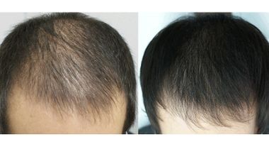 Mezoterapija kose - mezo-hair protiv opadanja kose