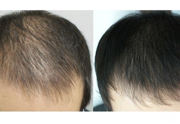 Mezoterapija kose - mezo-hair protiv opadanja kose
