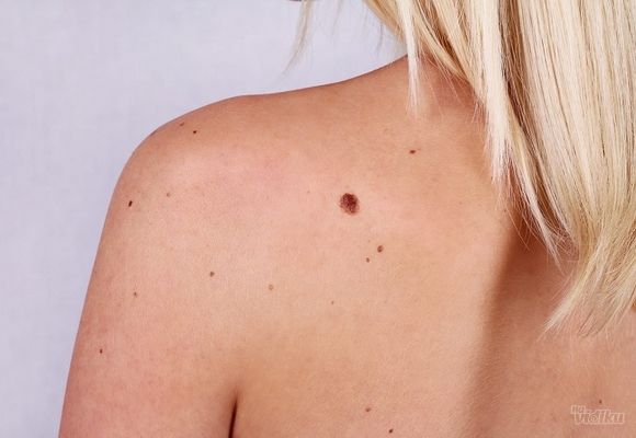 Dermoskopija svih promena na koži u dermatološkoj ordinaciji Diva!