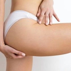 Topljenje celulita - kriolipoliza u estetskom laser centru Diva!