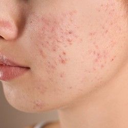 Lasersko lečenje akni u estetskom laser centru Diva!